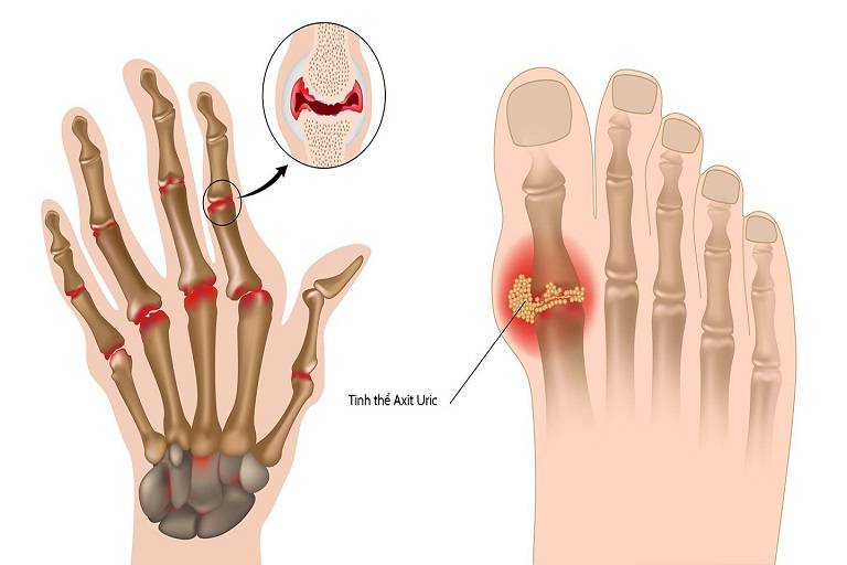 Tiêu chuẩn chẩn đoán viêm khớp dạng thấp theo ACR/EULAR