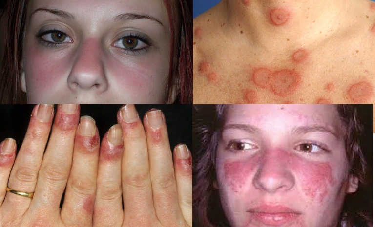 Nổi mề đay nhưng không ngứa có thể là dấu hiệu cảnh báo bệnh lupus ban đỏ