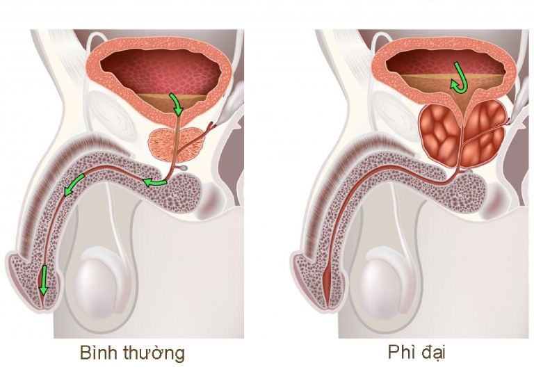 Phì đại tuyến tuyền liệt có thể gấp 5 lần so với thể tích bình thường