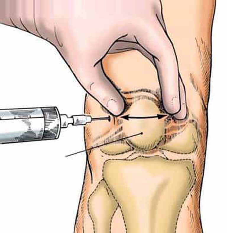 Vị trí và quy trình chọc hút dịch khớp gối