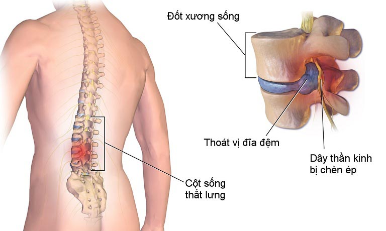 Phương pháp chữa thoát vị đĩa đệm bằng tế bào gốc