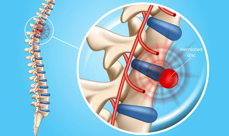 thoát vị đĩa đệm là gì