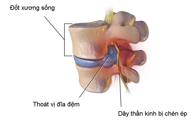 thoát vị đĩa đệm có nguy hiểm không