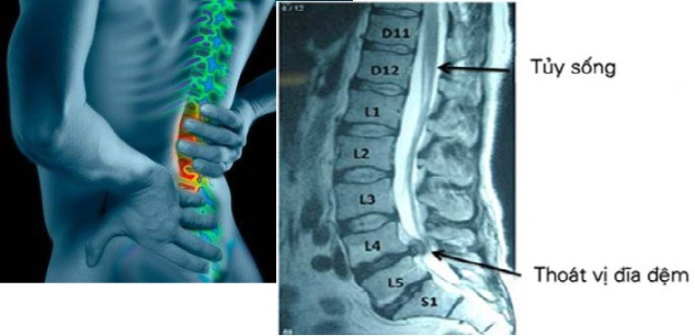 chẩn đoán thoát vị đĩa đệm