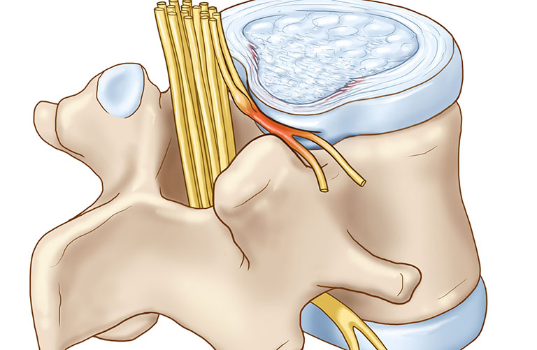 Các biến chứng nguy hiểm của thoát vị đĩa đệm