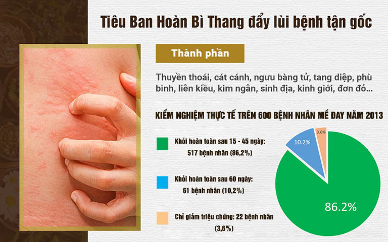 Tiêu ban hoàn bì thang chữa mề đay hiệu quả, đã kiểm nghiệm thực tế