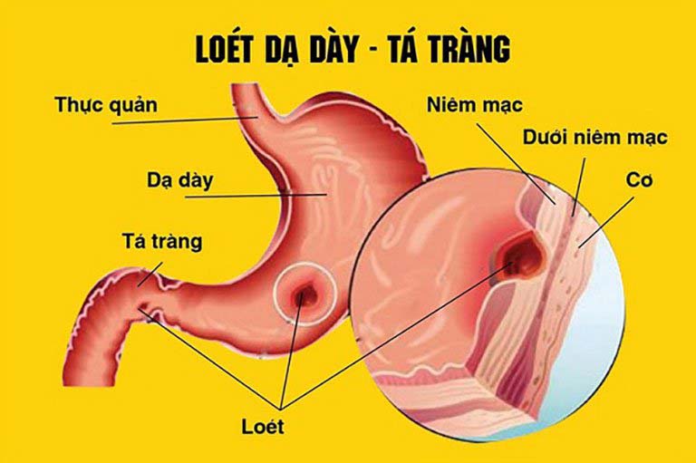 Trào ngược dịch mật