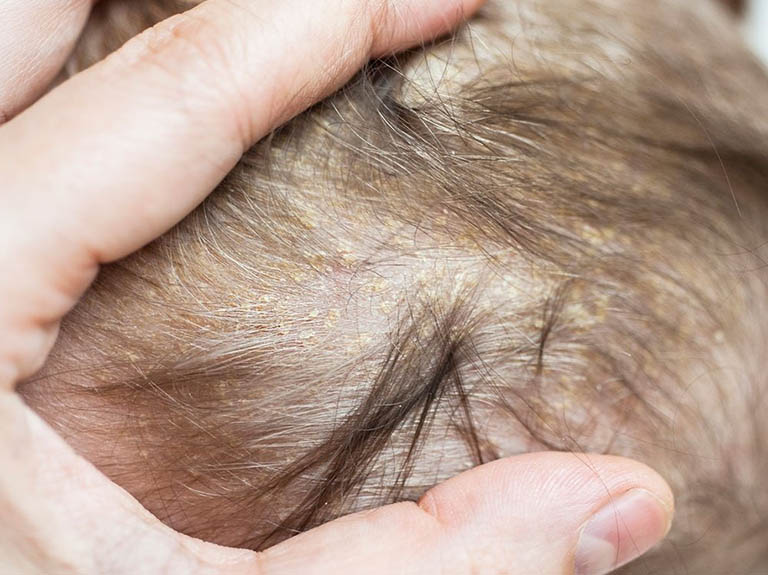 viêm da tiết bã da đầu ở trẻ sơ sinh