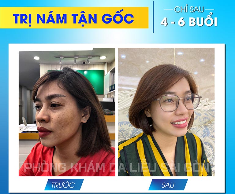 tri-nam-da-phong-kham-da-lieu-sai-gon Trị nám da phòng khám da liễu sài gòn