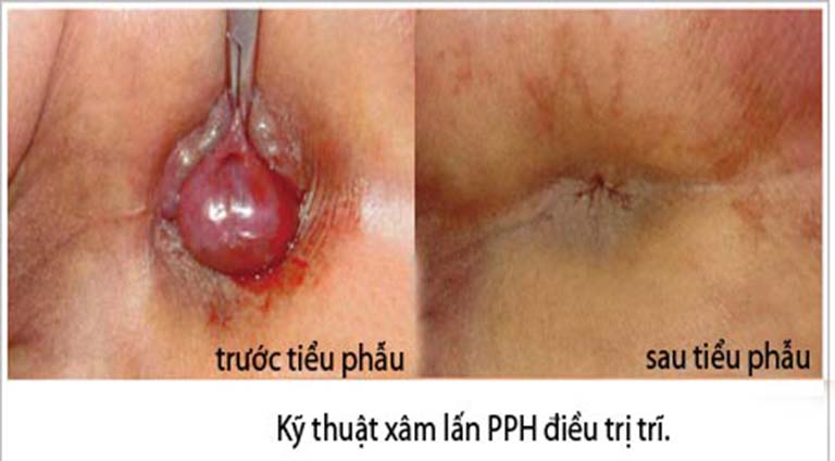 Trĩ ngoại độ 4