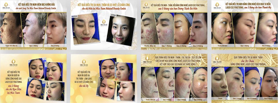 Trị sẹo Miss Trâm tại TPHCM