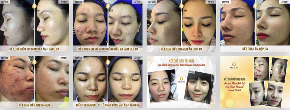 Trị sẹo TPHCM tại Miss Tram spa