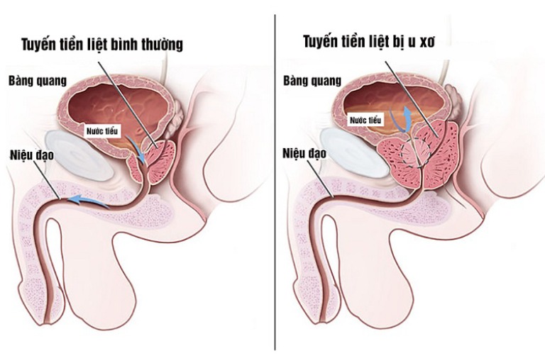 U xơ tuyến tuyền liệt thường gặp ở nam giới lớn tuổi