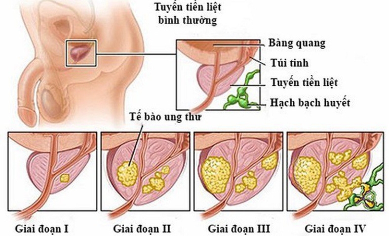 U xơ tuyến tuyền liệt nếu không điều trị kịp thời có thể dẫn đến ung thư