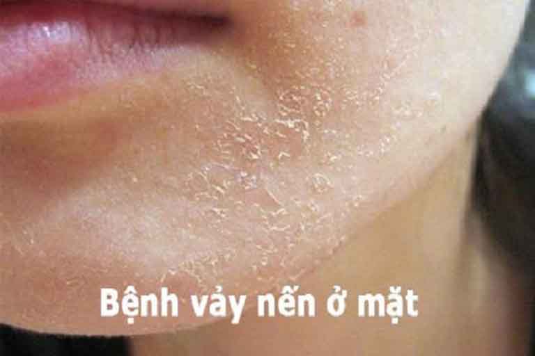 Vảy nến ở mặt