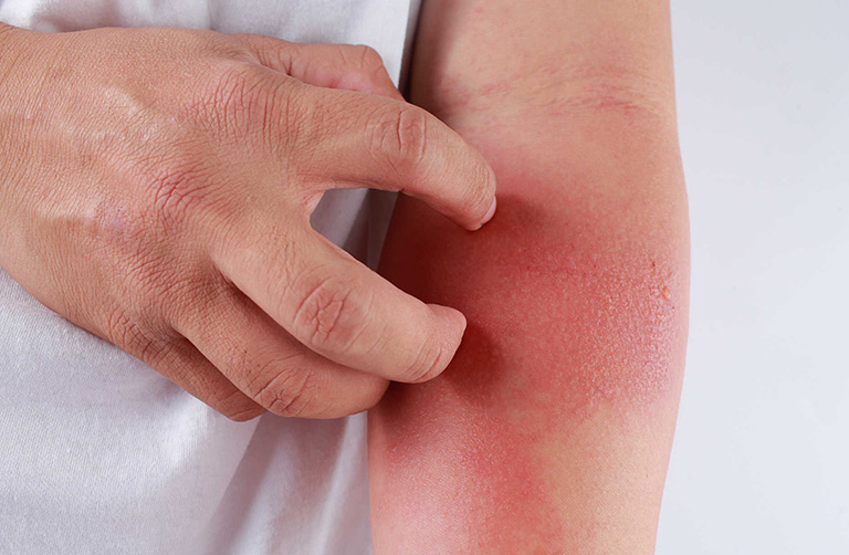hình ảnh viêm da tiếp xúc hình ảnh viêm da tiếp xúc
