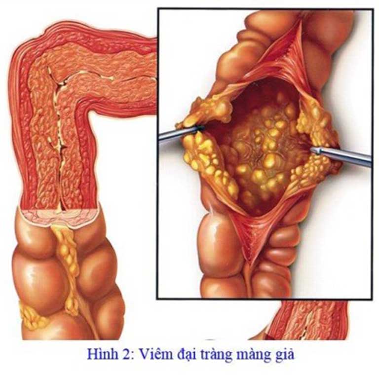 Viêm đại tràng giả mạc