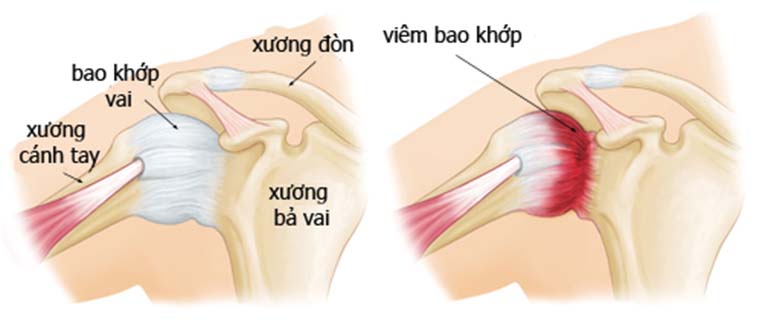 Viêm quanh khớp vai thể đông cứng là gì