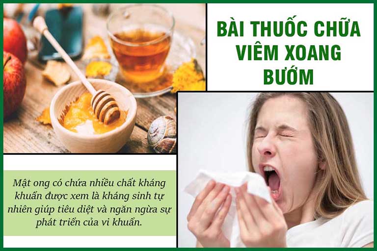 Viêm xoang bướm