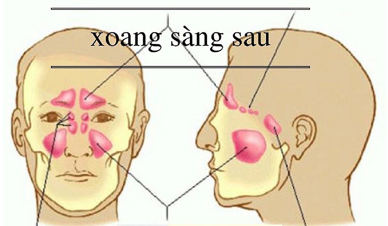 Viêm xoang sàng là gì? Cách điều trị như thế nào?