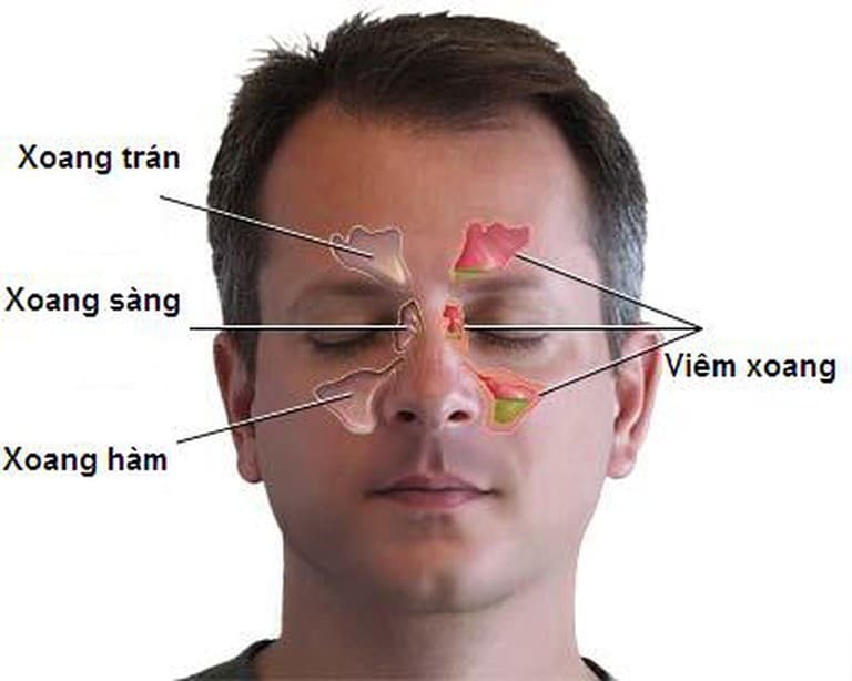 nguyên nhân gây viêm xoang sàng sau