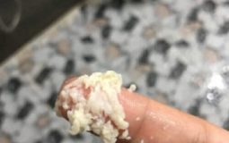 [ Cùng tìm hiểu] Khí hư màu trắng đục như bã đậu