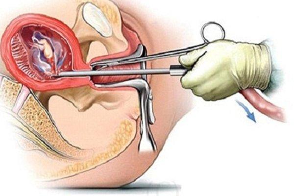 Cách phá thai 2 tuần tuổi bằng phương pháp hút thai