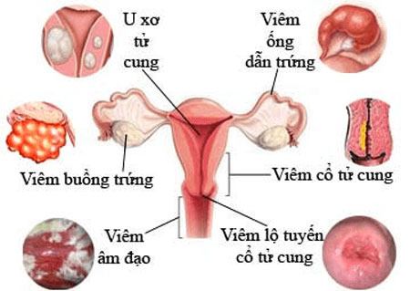 Dấu hiệu trễ kinh 1 tháng do viêm lộ tuyến cổ tử cung