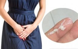 [Khí hư vón cục] Nguyên nhân và Cách điều trị bệnh hiệu quả, dứt điểm