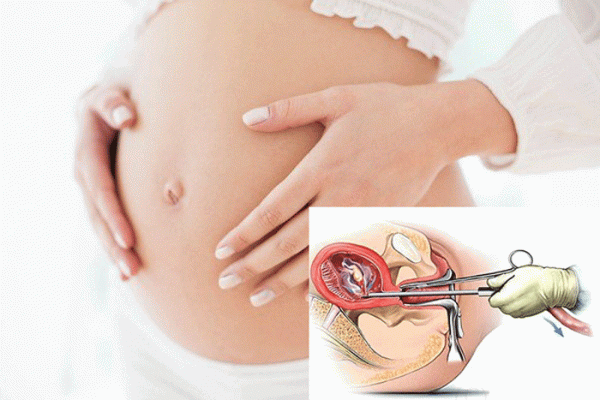4 Bước cơ bản thực hiện nong gắp thai an toàn