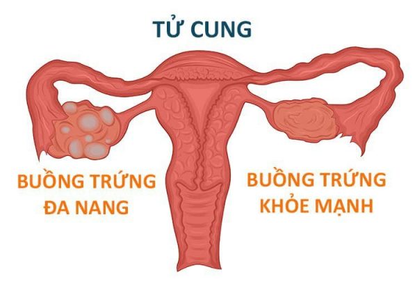 Buồng trứng đa nang - Nguyên nhân trễ kinh ở phụ nữ