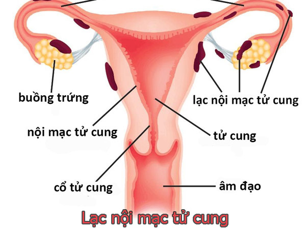 lạc nội mạc tử cung là một trong những nguyên nhân gây đau bụng kinh